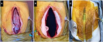 Vacuum assisted closure for defects of the abdominal wall after intestinal transplantation